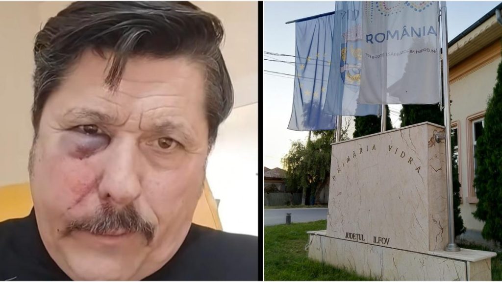 „Au atacat cu ură, voiau să mă omore”. Un consilier local AUR a ajuns la spital cu o fractură facială… Au atacat cu ura voiau sa ma omore Un consilier local AUR a ajuns la spital cu o fractura faciala